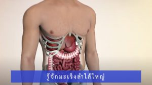 Colon Cancer